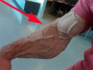 Тромбоз глубоких вен нижних конечностей: симптомы, лечение, диета Тромбоз глубоких вен нижних конечностей: симптомы, лечение, диета