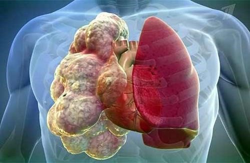 Эмфизема легких – не приговор, увеличиваем продолжительность жизни Эмфизема легких – не приговор, увеличиваем продолжительность жизни