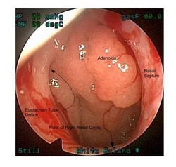 Особенности эндоскопического удаления аденоидов Особенности эндоскопического удаления аденоидов
