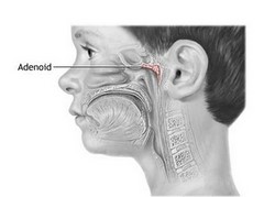 Особенности эндоскопического удаления аденоидов Особенности эндоскопического удаления аденоидов