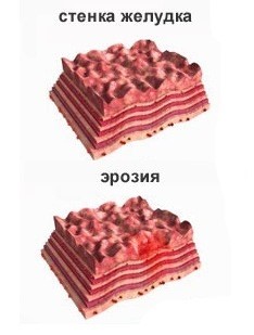 Лечение эрозии желудка Лечение эрозии желудка