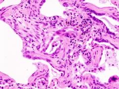 Фиброз легких Фиброз легких