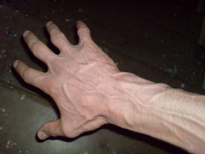 Как бороться с заболеваниями вен на руках? Как бороться с заболеваниями вен на руках?