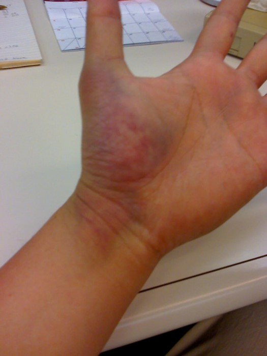 Как бороться с заболеваниями вен на руках? Как бороться с заболеваниями вен на руках?