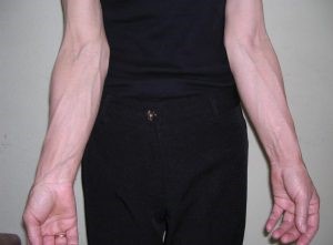 Как бороться с заболеваниями вен на руках? Как бороться с заболеваниями вен на руках?