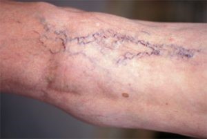 Как бороться с заболеваниями вен на руках? Как бороться с заболеваниями вен на руках?
