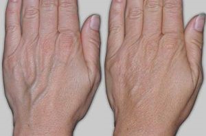 Как бороться с заболеваниями вен на руках? Как бороться с заболеваниями вен на руках?