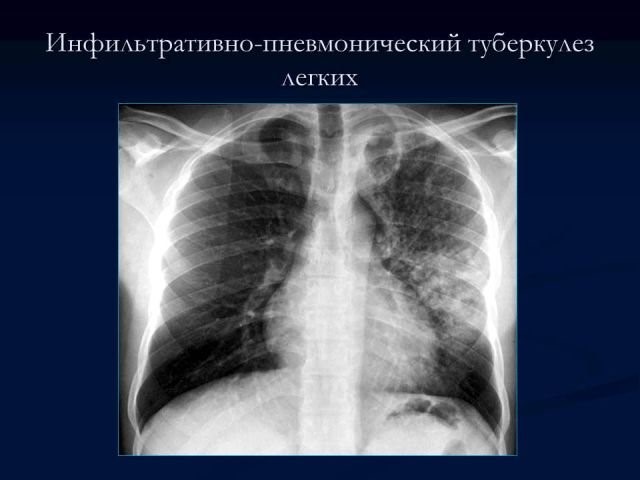 Необходимость проведения флюорографии при пневмонии Необходимость проведения флюорографии при пневмонии