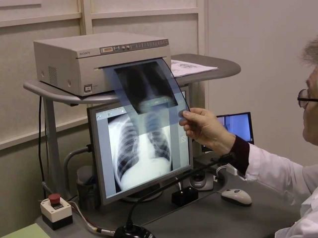 Необходимость проведения флюорографии при пневмонии Необходимость проведения флюорографии при пневмонии