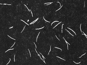 Тяжелый гельминтоз - бычий цепень у человека Тяжелый гельминтоз - бычий цепень у человека