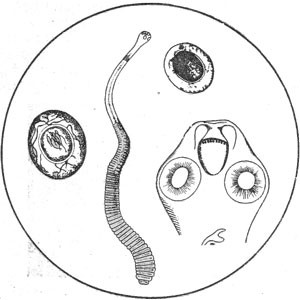 Тяжелый гельминтоз - бычий цепень у человека Тяжелый гельминтоз - бычий цепень у человека