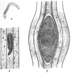 Тяжелый гельминтоз - бычий цепень у человека Тяжелый гельминтоз - бычий цепень у человека
