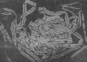 Тяжелый гельминтоз - бычий цепень у человека Тяжелый гельминтоз - бычий цепень у человека