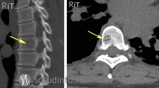 Гемангиома поясничного отдела позвоночника Гемангиома поясничного отдела позвоночника