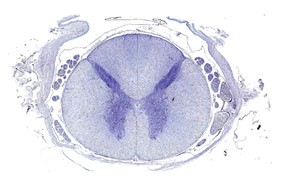 Гемангиома поясничного отдела позвоночника Гемангиома поясничного отдела позвоночника