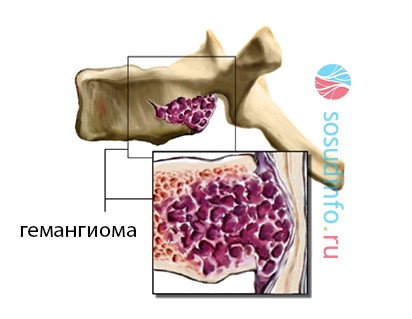 Гемангиома поясничного отдела позвоночника Гемангиома поясничного отдела позвоночника