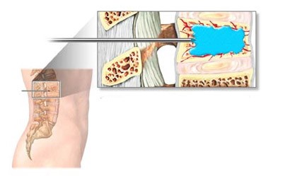Гемангиома поясничного отдела позвоночника Гемангиома поясничного отдела позвоночника