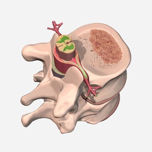 Гемангиома поясничного отдела позвоночника Гемангиома поясничного отдела позвоночника