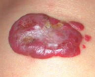 Венозная гемангиома сосудов Венозная гемангиома сосудов