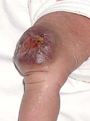 Венозная гемангиома сосудов Венозная гемангиома сосудов