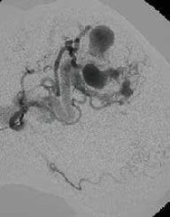 Венозная гемангиома сосудов Венозная гемангиома сосудов