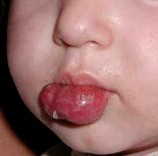 Венозная гемангиома сосудов Венозная гемангиома сосудов