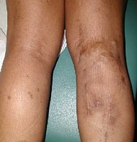 Венозная гемангиома сосудов Венозная гемангиома сосудов