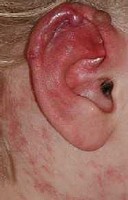 Венозная гемангиома сосудов Венозная гемангиома сосудов