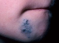 Венозная гемангиома сосудов Венозная гемангиома сосудов