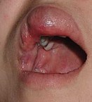 Венозная гемангиома сосудов Венозная гемангиома сосудов