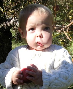 Венозная гемангиома сосудов Венозная гемангиома сосудов