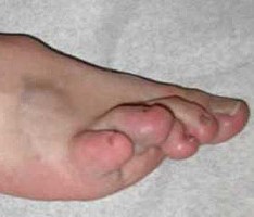 Венозная гемангиома сосудов Венозная гемангиома сосудов