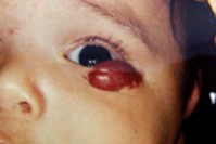 Венозная гемангиома сосудов Венозная гемангиома сосудов