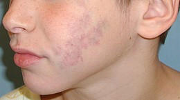 Венозная гемангиома сосудов Венозная гемангиома сосудов