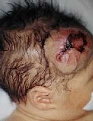 Венозная гемангиома сосудов Венозная гемангиома сосудов