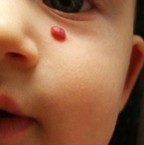 Венозная гемангиома сосудов Венозная гемангиома сосудов