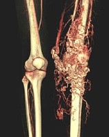 Венозная гемангиома сосудов Венозная гемангиома сосудов
