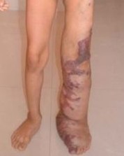 Венозная гемангиома сосудов Венозная гемангиома сосудов