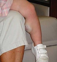 Венозная гемангиома сосудов Венозная гемангиома сосудов