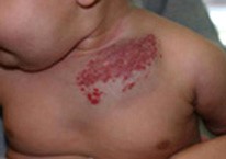 Венозная гемангиома сосудов Венозная гемангиома сосудов