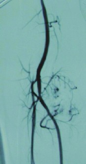 Венозная гемангиома сосудов Венозная гемангиома сосудов