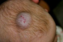 Венозная гемангиома сосудов Венозная гемангиома сосудов