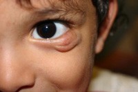 Венозная гемангиома сосудов Венозная гемангиома сосудов