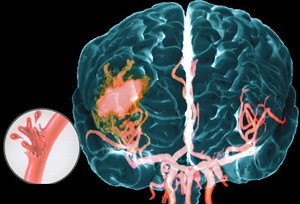 Геморрагический инсульт и его лечение Геморрагический инсульт и его лечение