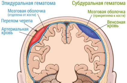 Геморрагический инсульт и его лечение Геморрагический инсульт и его лечение