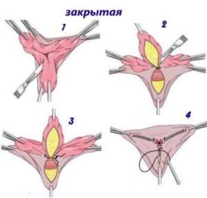 Геморроидэктомия: операция по удалению геморроя, геморроидальных узлов Геморроидэктомия: операция по удалению геморроя, геморроидальных узлов
