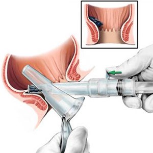Геморроидэктомия: операция по удалению геморроя, геморроидальных узлов Геморроидэктомия: операция по удалению геморроя, геморроидальных узлов