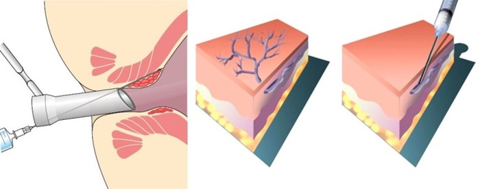 Геморроидэктомия: операция по удалению геморроя, геморроидальных узлов Геморроидэктомия: операция по удалению геморроя, геморроидальных узлов