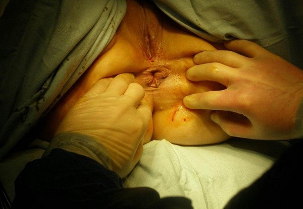 Признаки геморроя у девушек и женщин Признаки геморроя у девушек и женщин