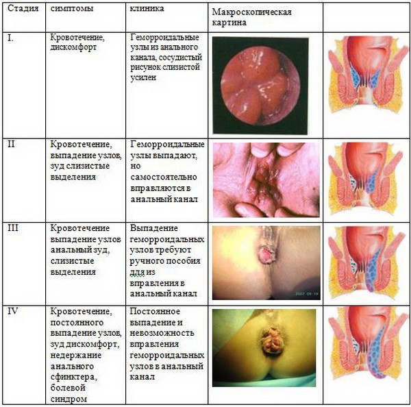 Признаки геморроя у девушек и женщин Признаки геморроя у девушек и женщин